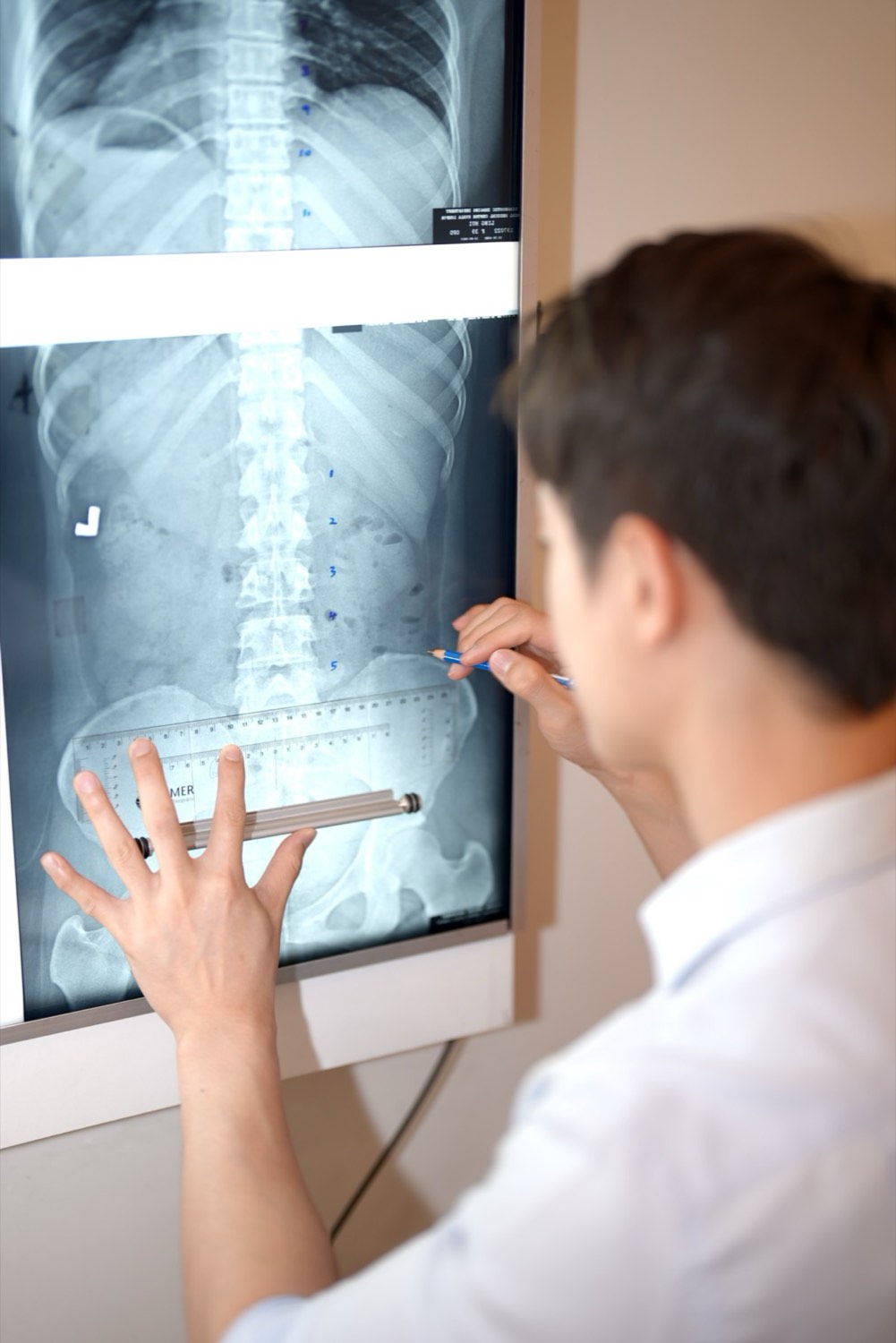 A full-length spinal X-ray on a lightbox being measured with a ruler